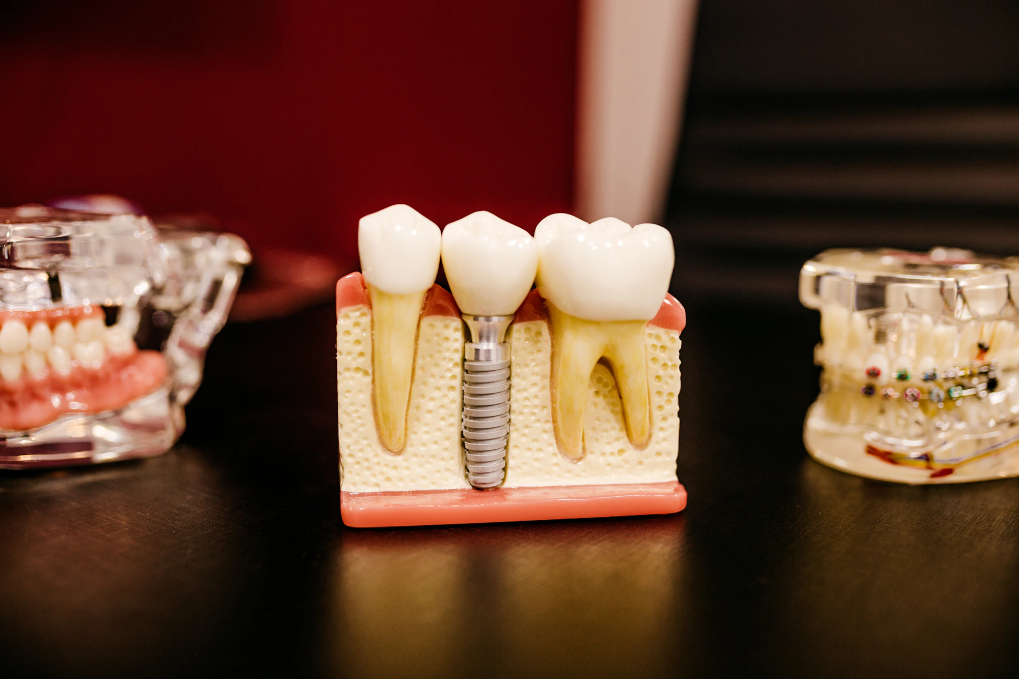 Dental models showing a crown, an implant and a denture