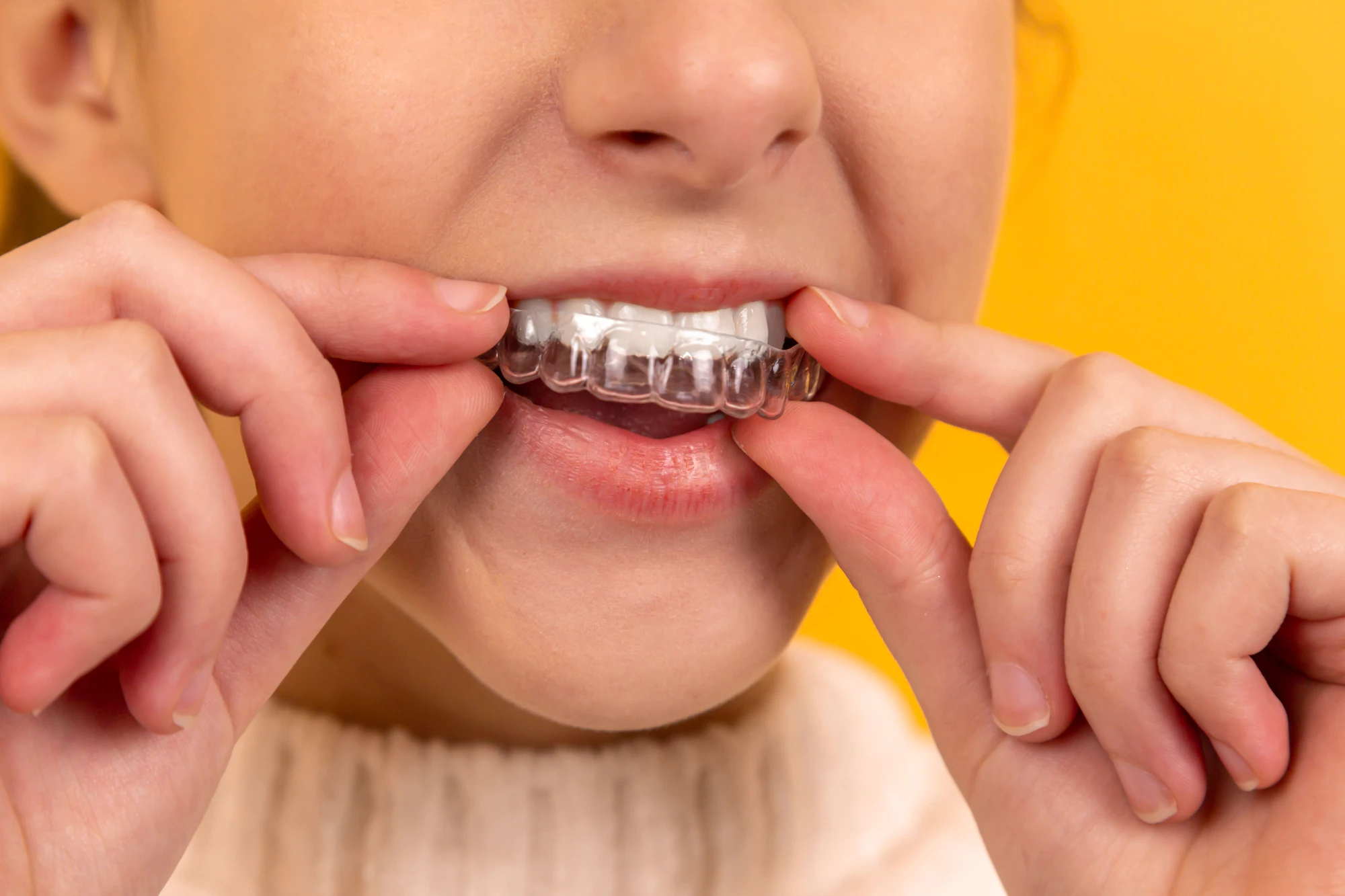 A person fitting a clear aligner over their upper teeth